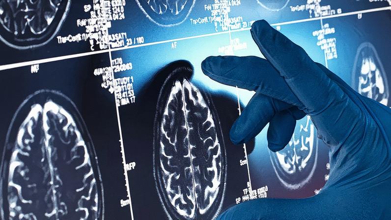 Lítio pode revolucionar tratamento do Alzheimer, aponta pesquisa de Harvard