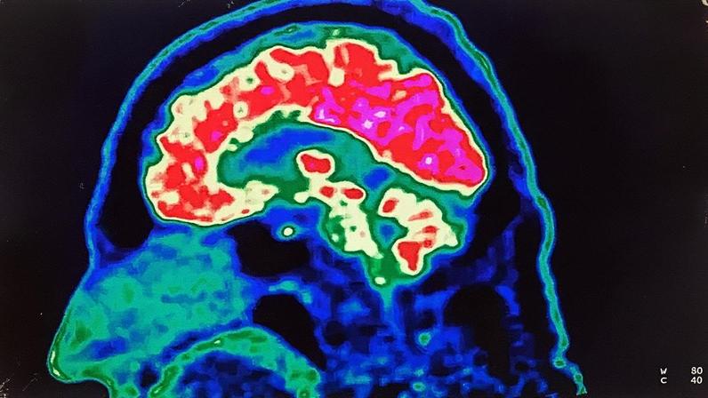 O aquecimento global prejudica a saúde mental e o funcionamento cerebral humano