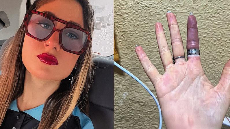 Bombeiros resgatam mulher com dedo preso em anel após inchaço intenso Bombeiros resgatam mulher com dedo preso em anel após inchaço intenso