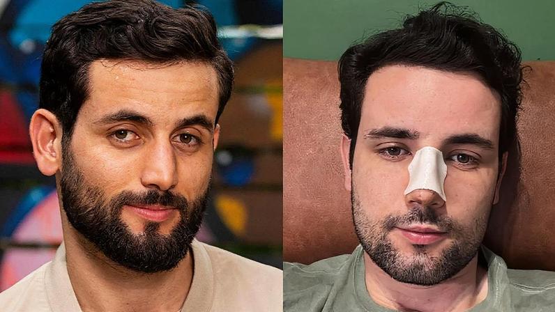 Rinoplastia de Matteus Amaral revela motivos estéticos e de saúde da cirurgia